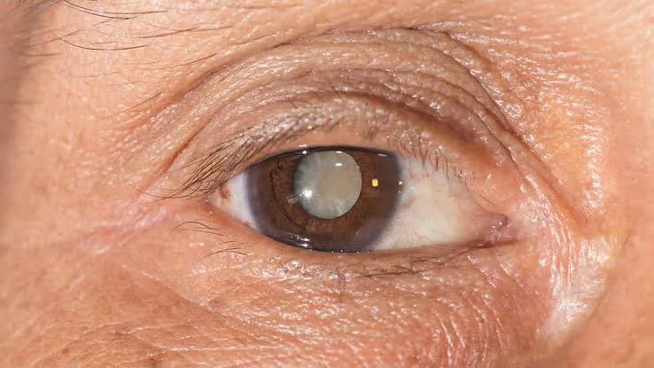Cirurgia de Catarata